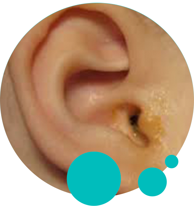 EAR DISCHARGE